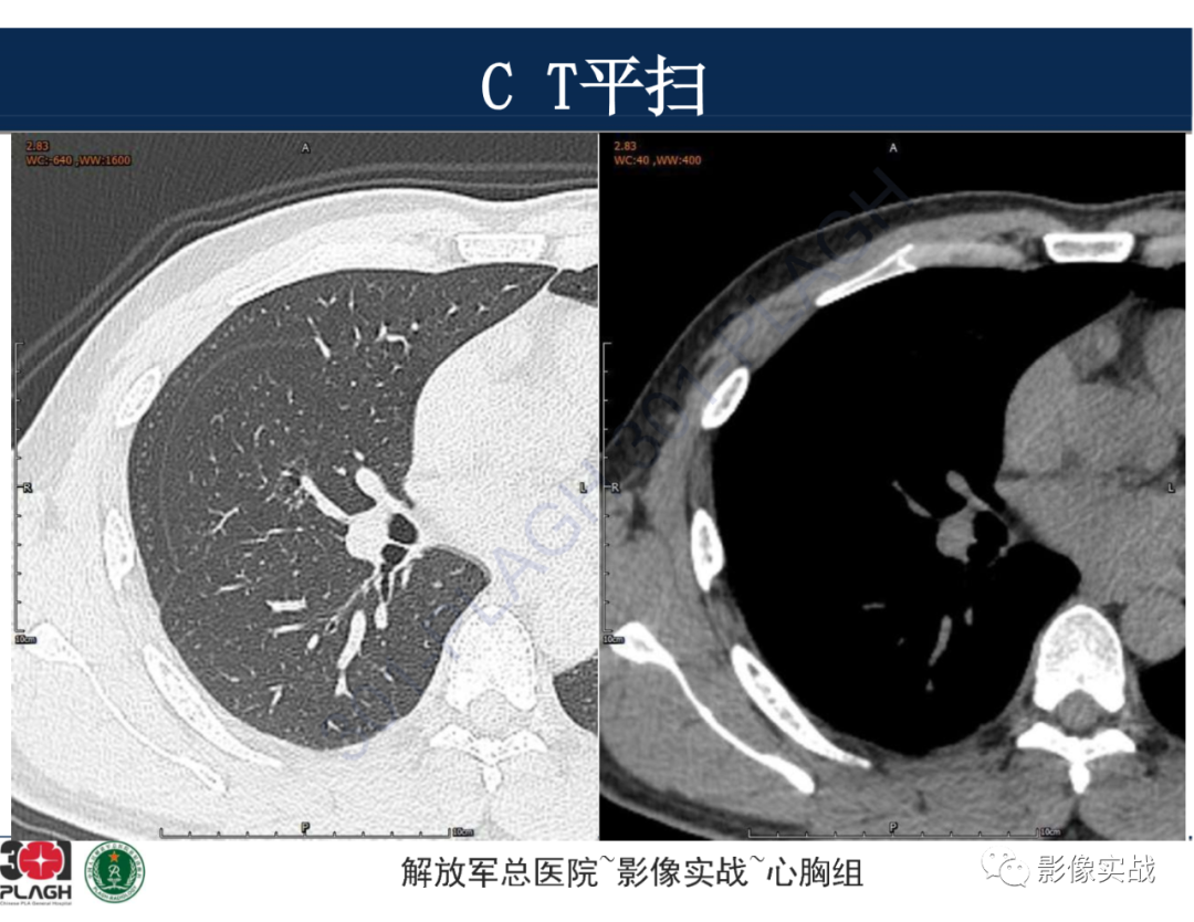 影像PPT - 【病例】肺浸润性腺癌1例CT-6