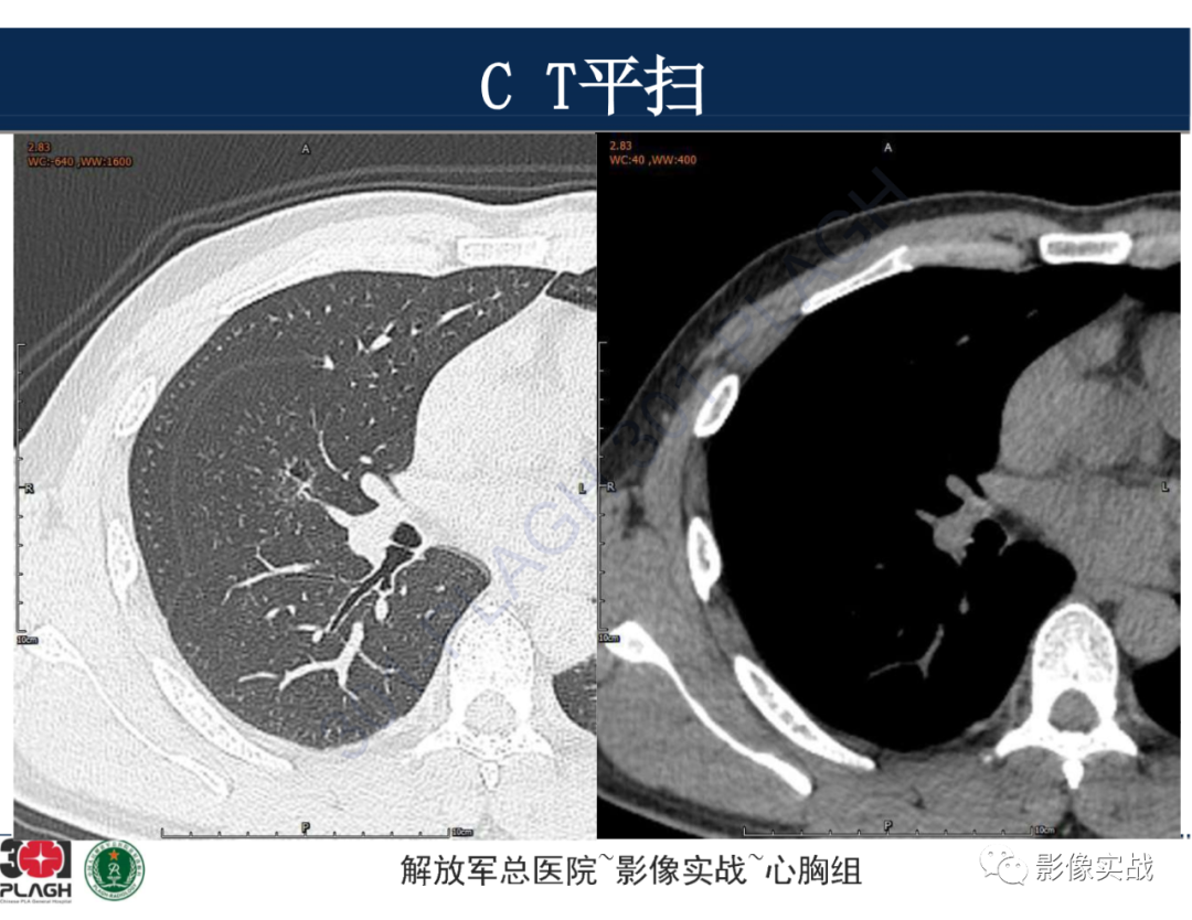 影像PPT - 【病例】肺浸润性腺癌1例CT-5