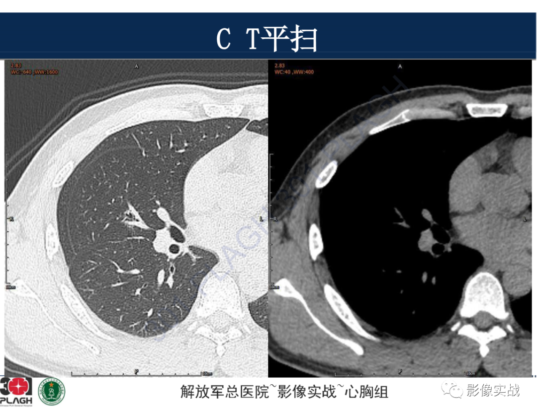 影像PPT - 【病例】肺浸润性腺癌1例CT-7