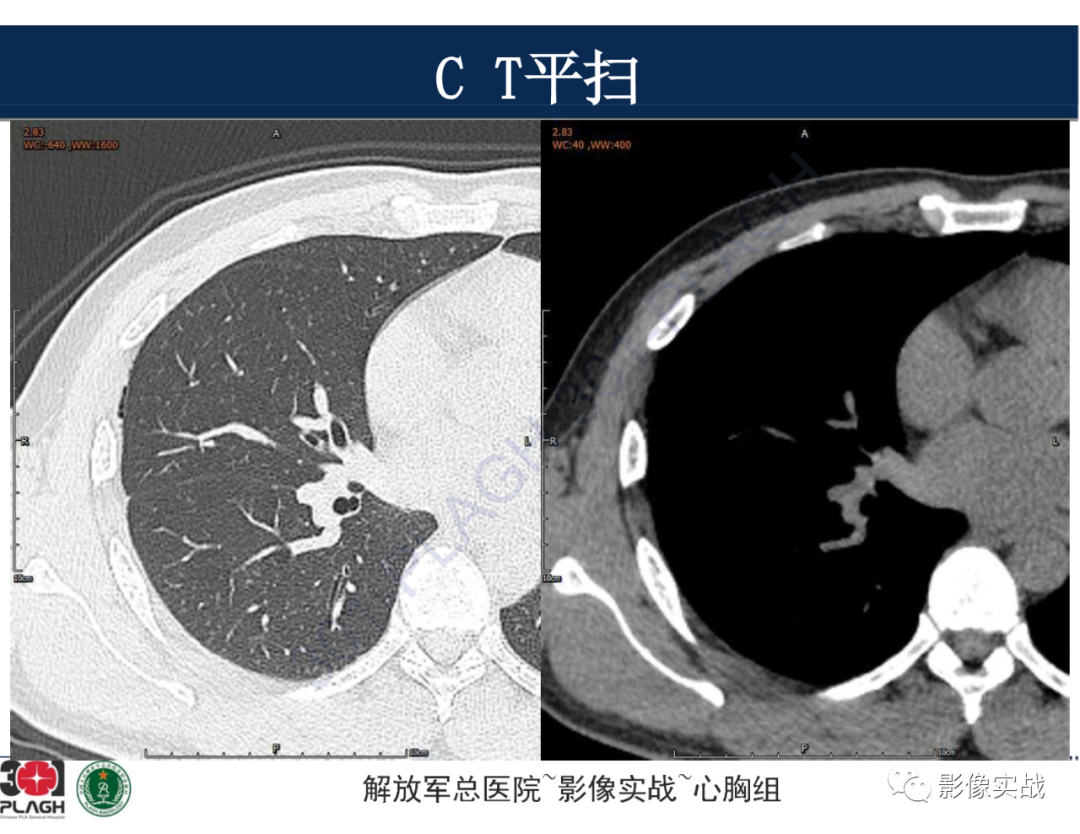 影像PPT - 【病例】肺浸润性腺癌1例CT-9