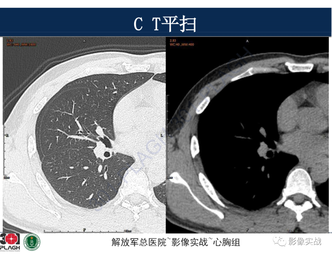 影像PPT - 【病例】肺浸润性腺癌1例CT-8