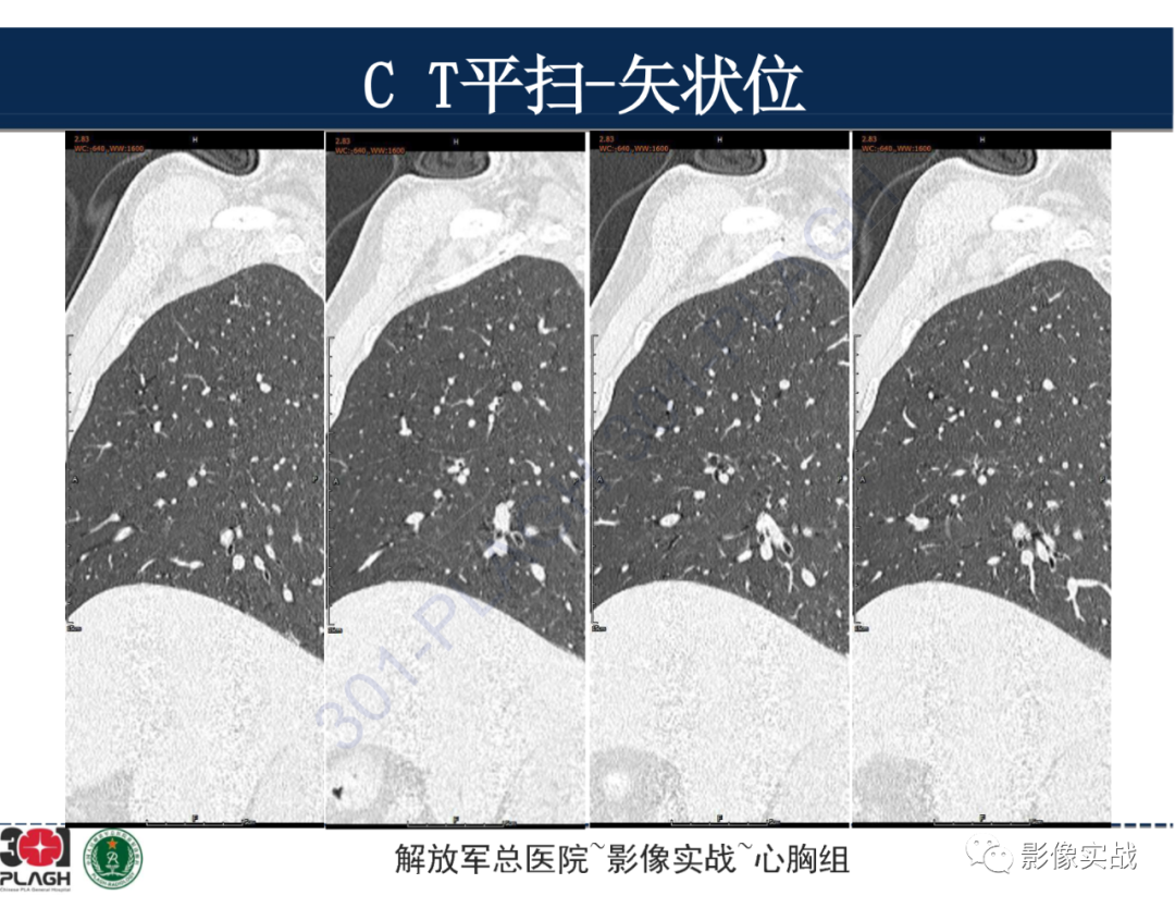 影像PPT - 【病例】肺浸润性腺癌1例CT-10