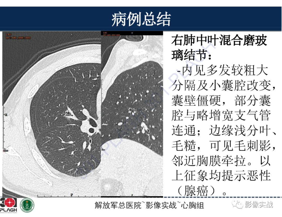 影像PPT - 【病例】肺浸润性腺癌1例CT-13
