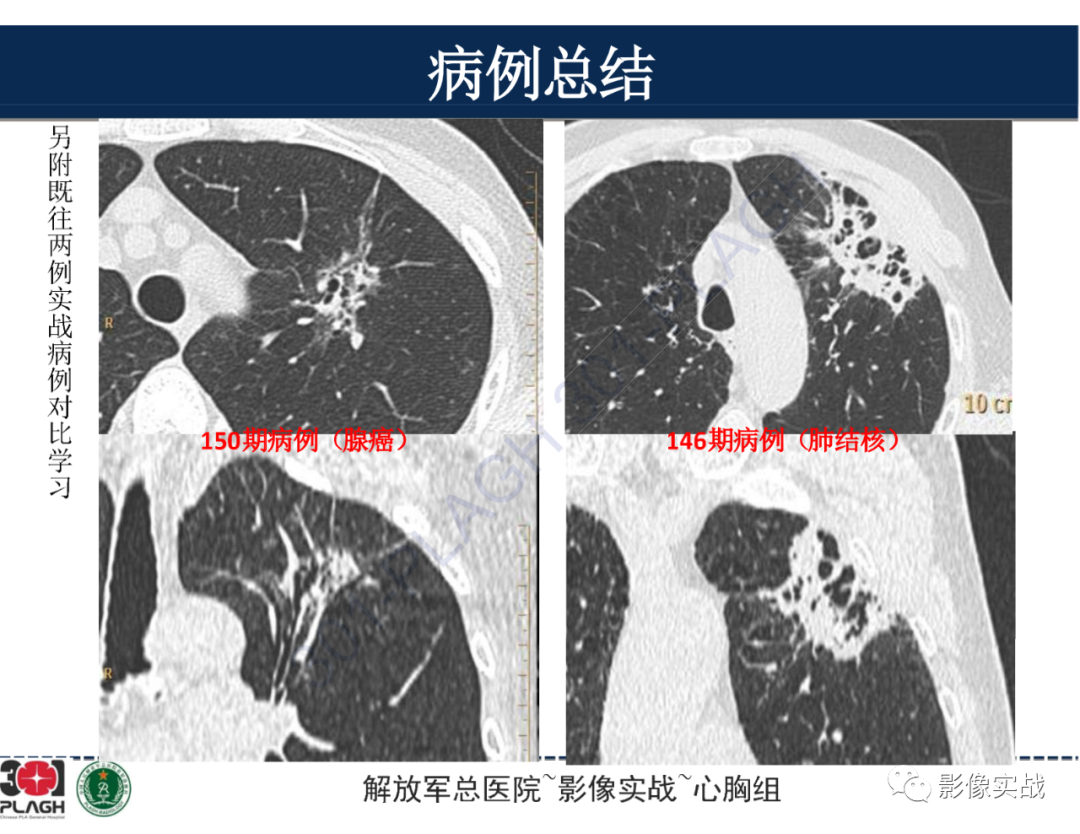 影像PPT - 【病例】肺浸润性腺癌1例CT-14