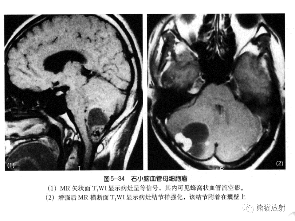影像PPT - 【病例】血管母细胞瘤2例MR影像-33