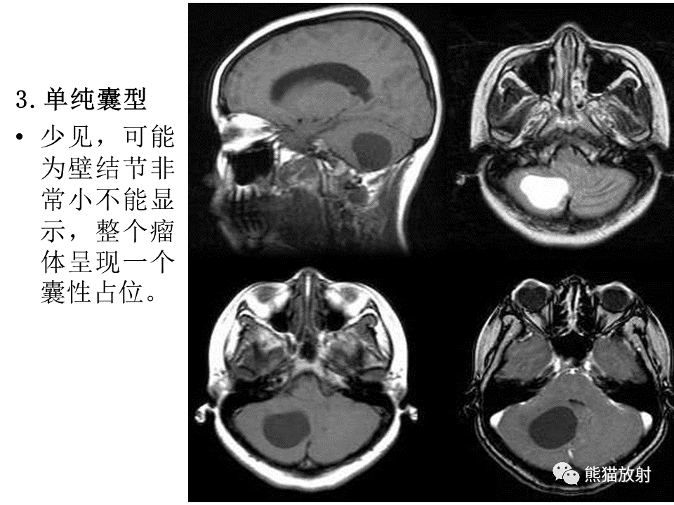 影像PPT - 【病例】血管母细胞瘤2例MR影像-36