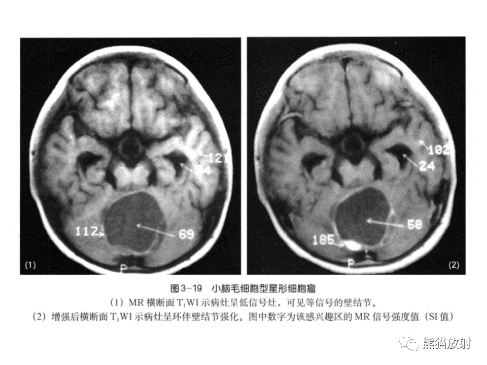 影像PPT - 【病例】血管母细胞瘤2例MR影像-38
