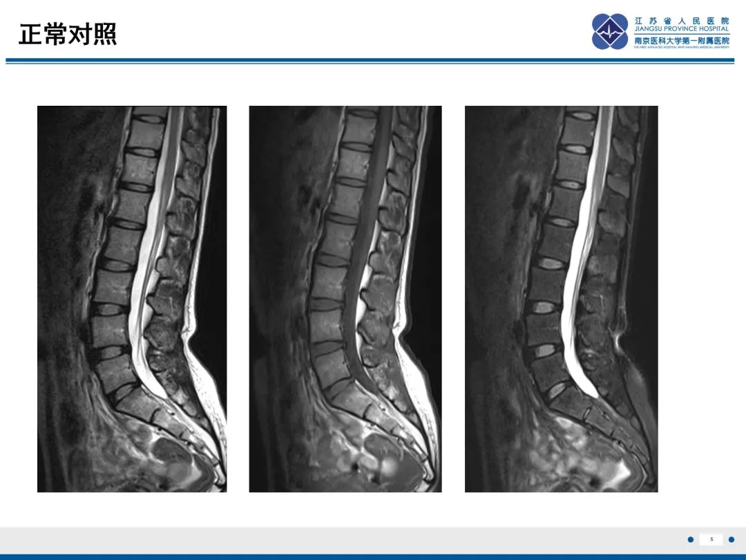 影像PPT - 【PPT】低颅压综合征-6