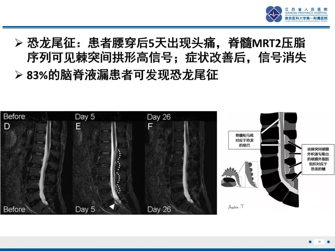 影像PPT - 【PPT】低颅压综合征-22