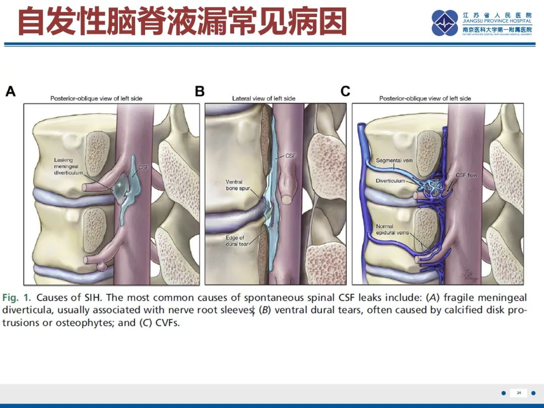 影像PPT - 【PPT】低颅压综合征-25
