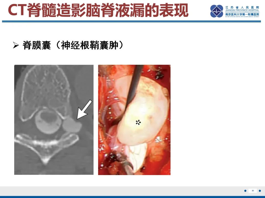 影像PPT - 【PPT】低颅压综合征-26