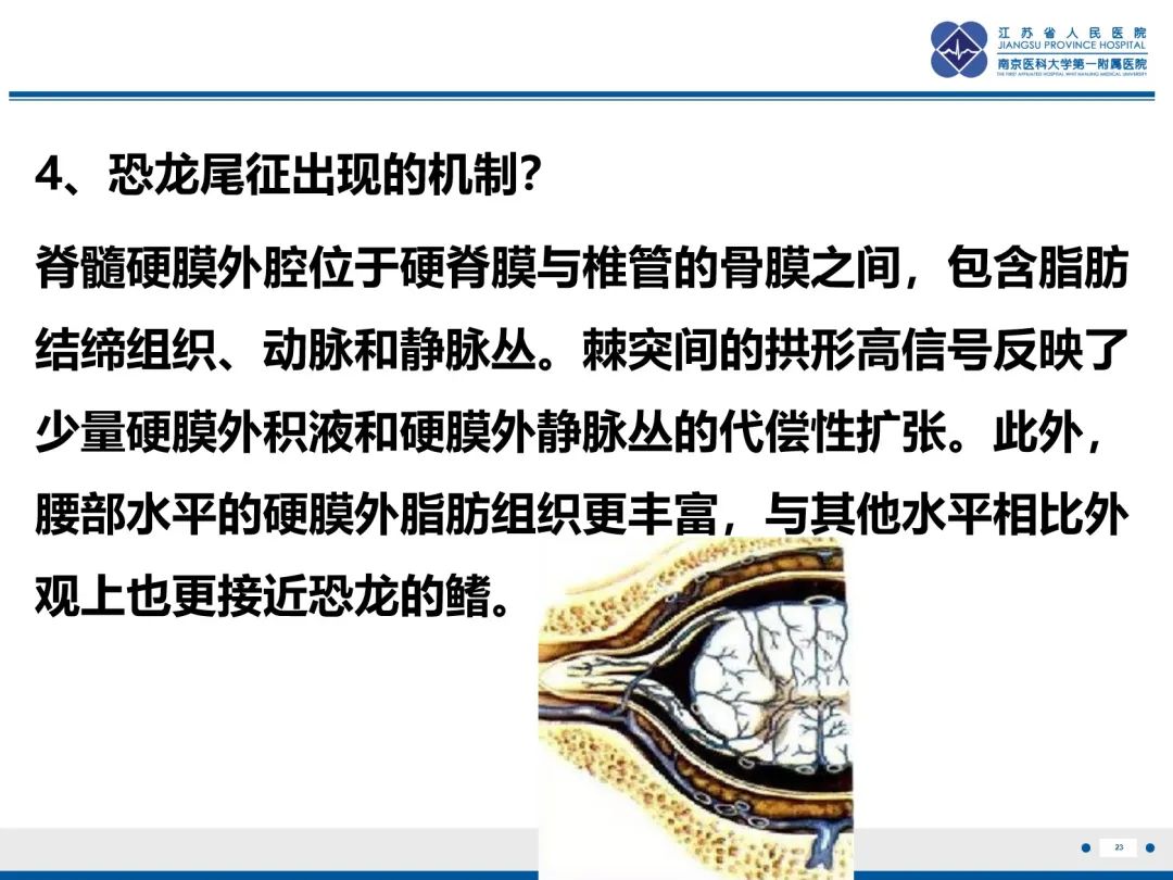 影像PPT - 【PPT】低颅压综合征-24