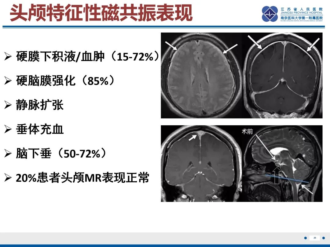 影像PPT - 【PPT】低颅压综合征-29