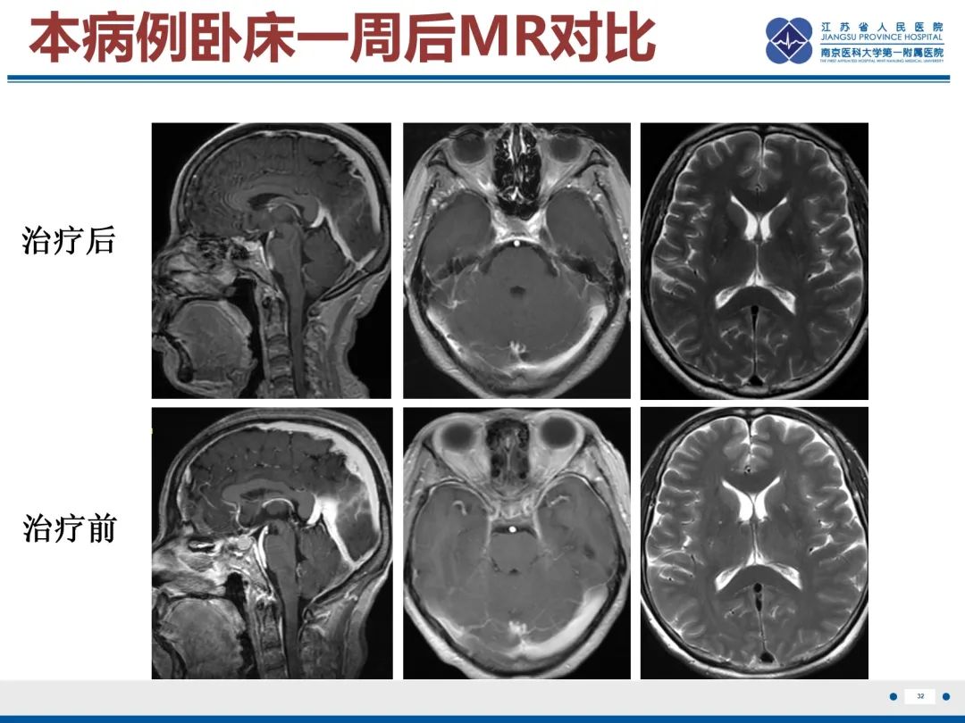 影像PPT - 【PPT】低颅压综合征-33