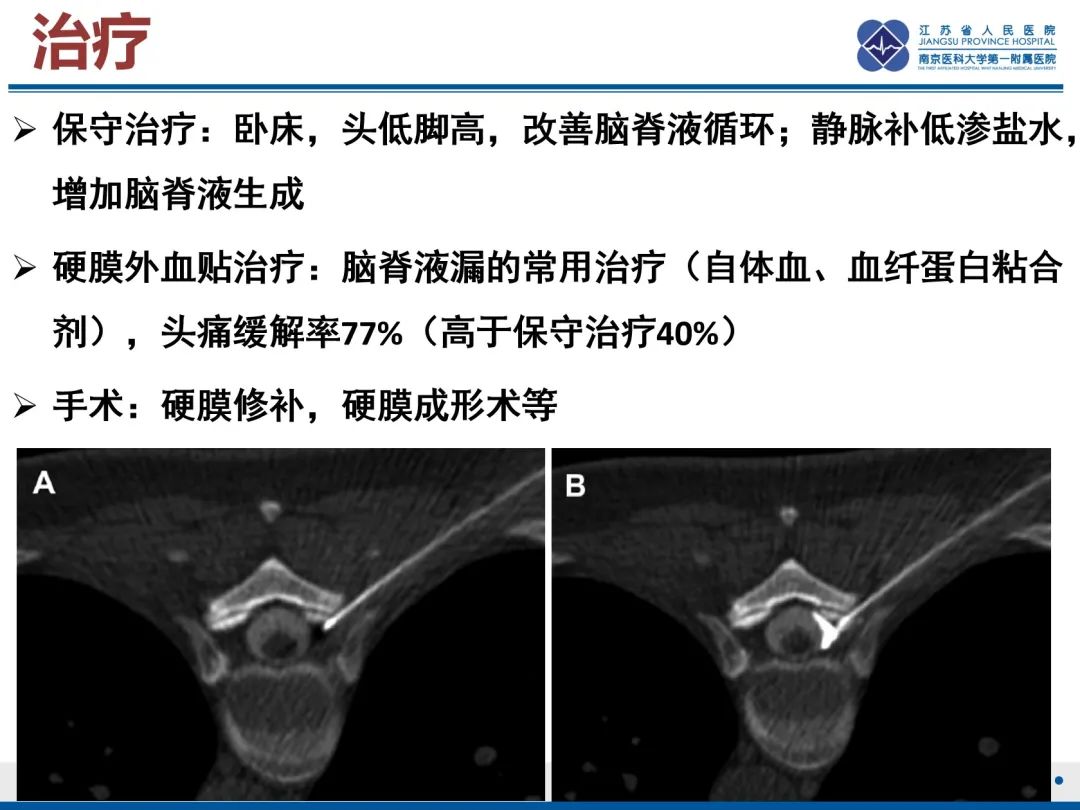 影像PPT - 【PPT】低颅压综合征-32