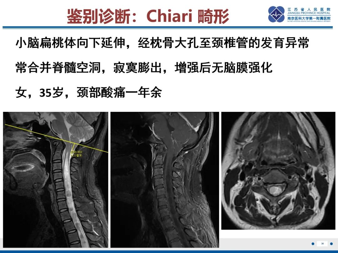 影像PPT - 【PPT】低颅压综合征-37