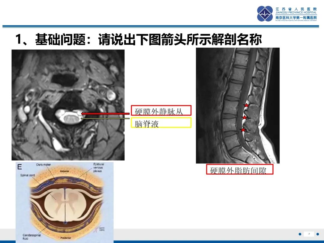 影像PPT - 【PPT】低颅压综合征-3
