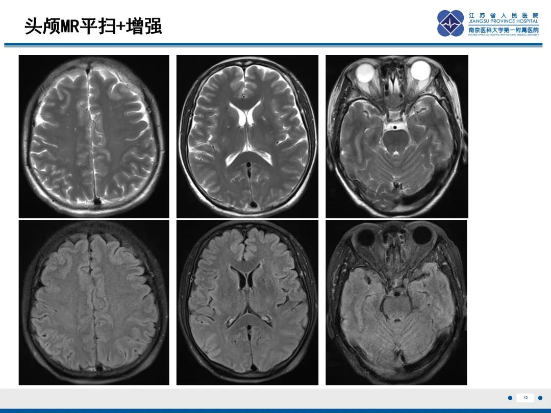 影像PPT - 【PPT】低颅压综合征-4