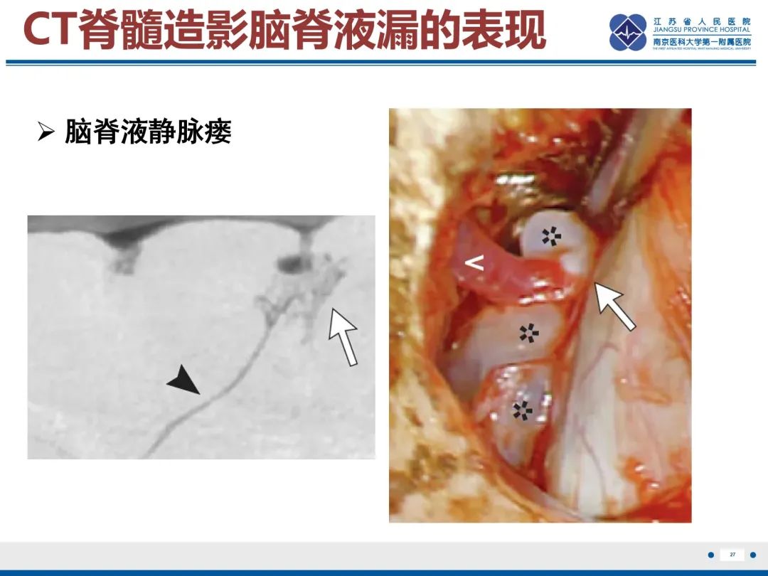 影像PPT - 【PPT】低颅压综合征-7