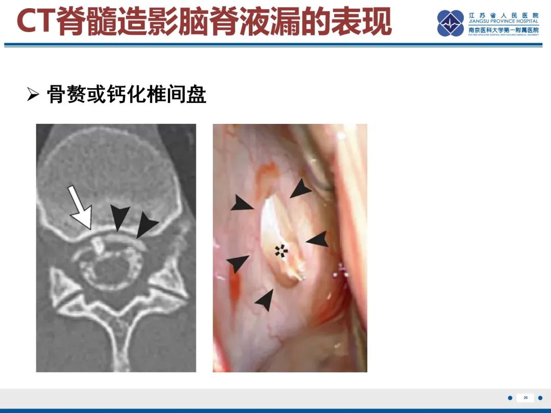影像PPT - 【PPT】低颅压综合征-6