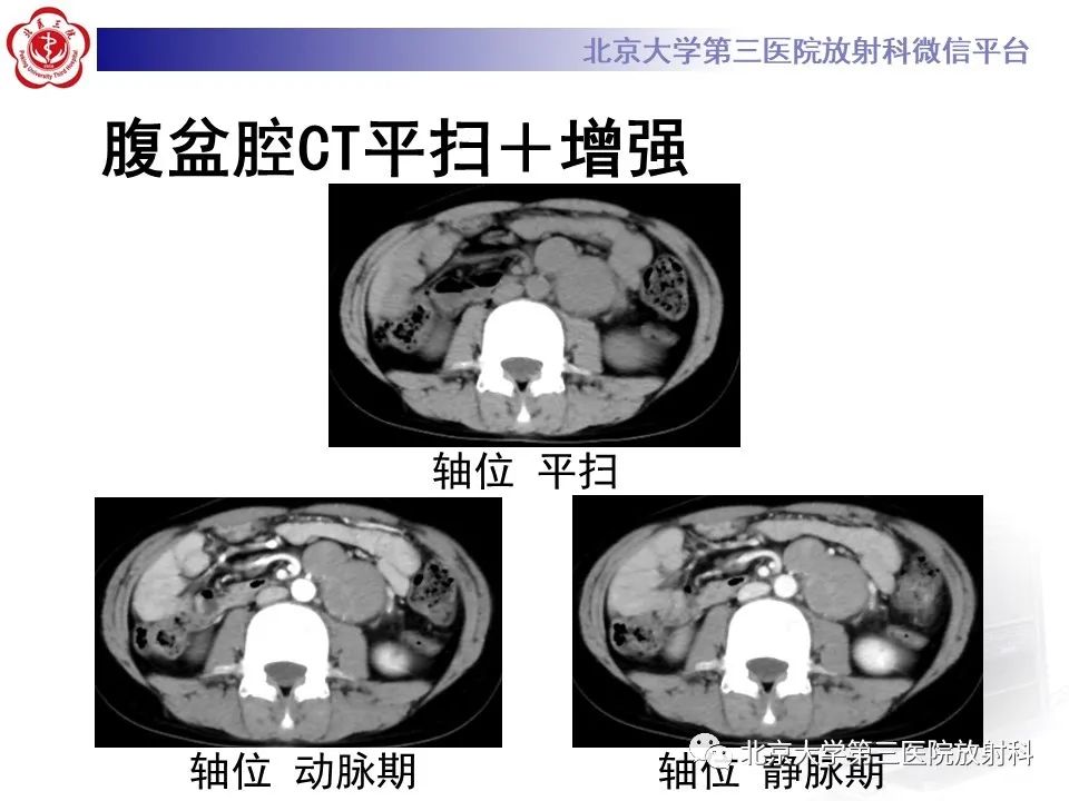 影像PPT - 【PPT】卵巢无性细胞瘤-4