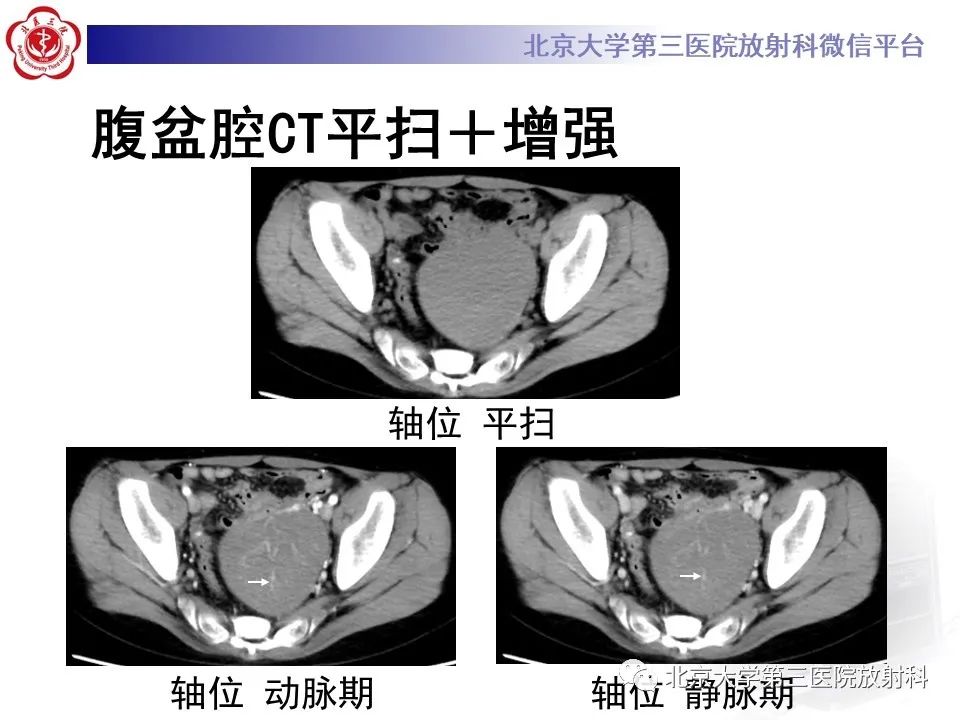 影像PPT - 【PPT】卵巢无性细胞瘤-3