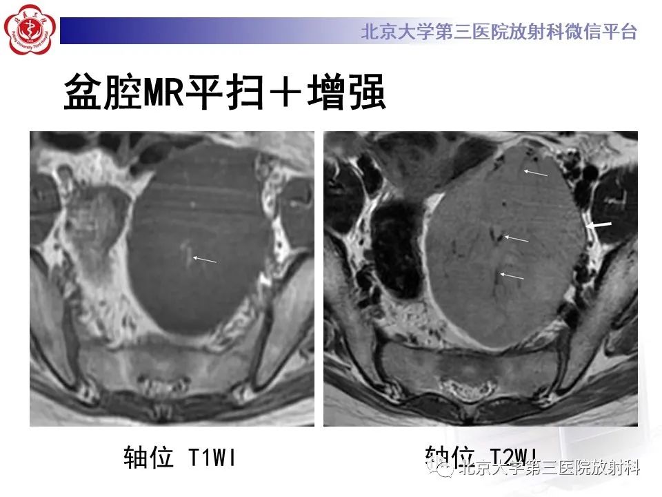 影像PPT - 【PPT】卵巢无性细胞瘤-6