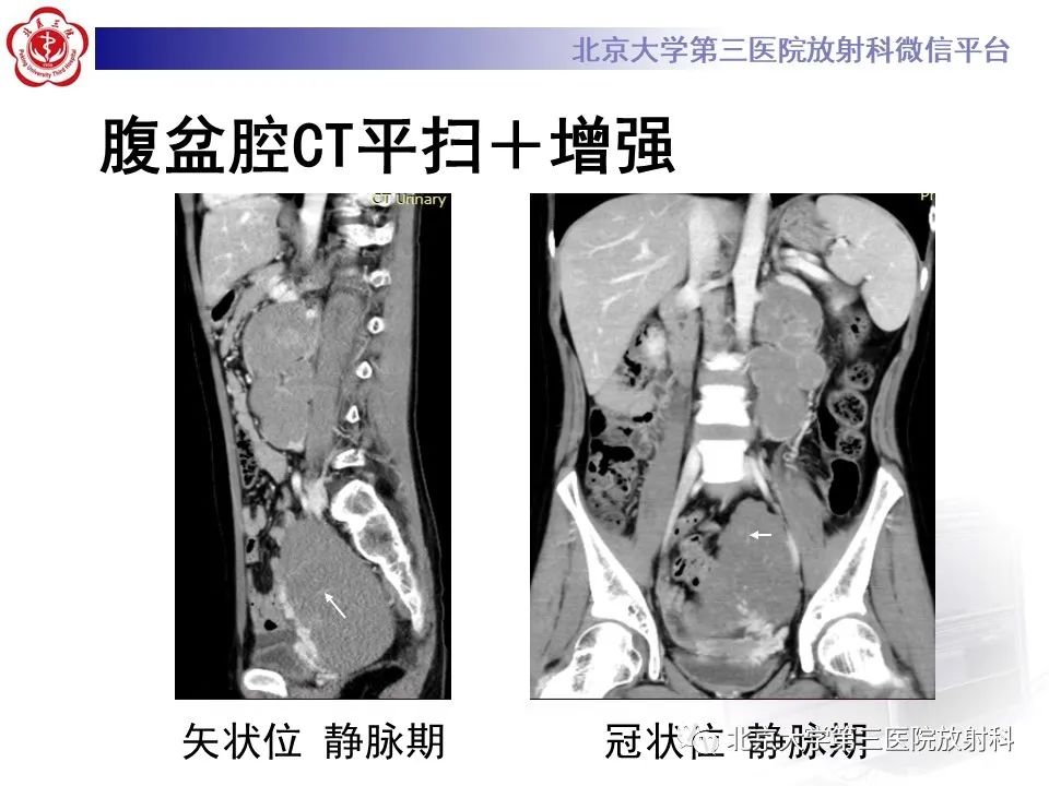 影像PPT - 【PPT】卵巢无性细胞瘤-5