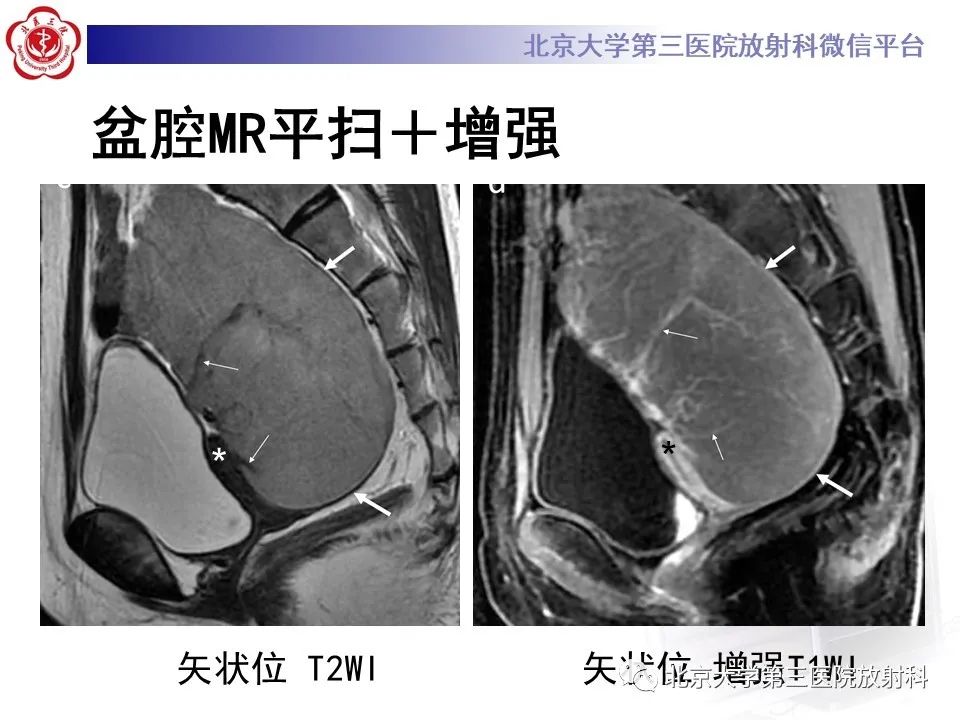 影像PPT - 【PPT】卵巢无性细胞瘤-7