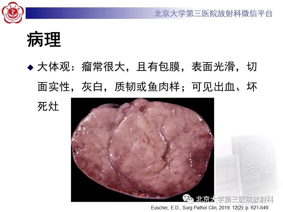 影像PPT - 【PPT】卵巢无性细胞瘤-17