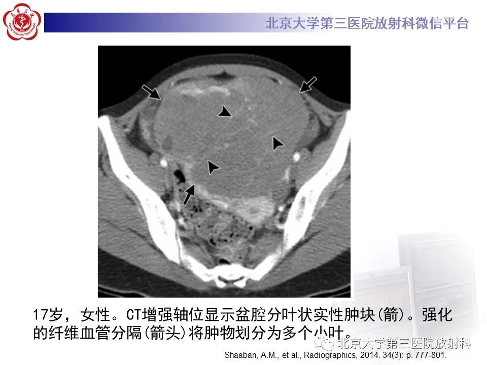 影像PPT - 【PPT】卵巢无性细胞瘤-23