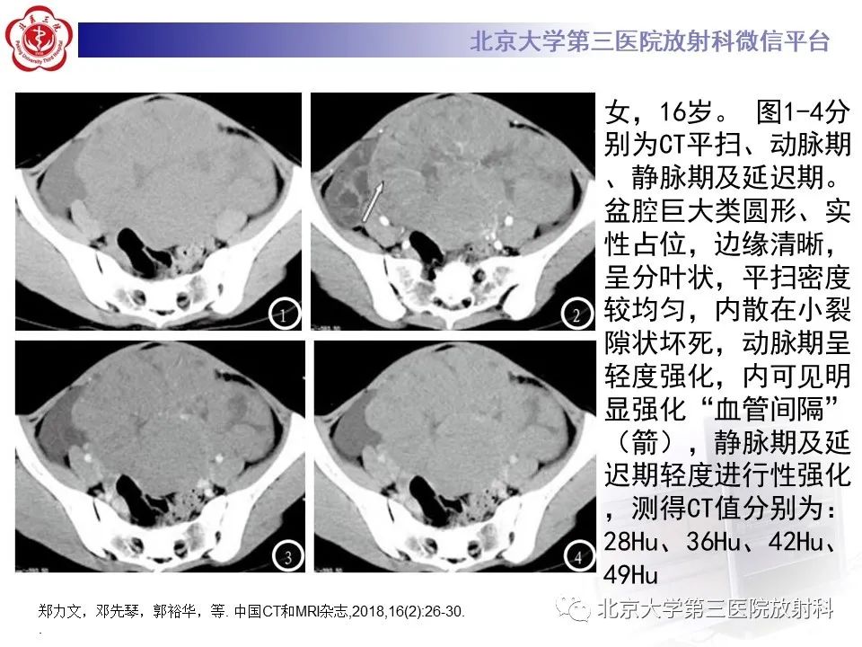 影像PPT - 【PPT】卵巢无性细胞瘤-24