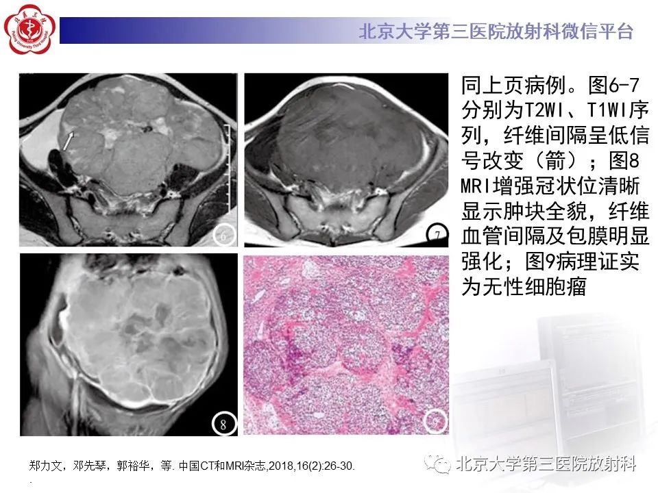 影像PPT - 【PPT】卵巢无性细胞瘤-25
