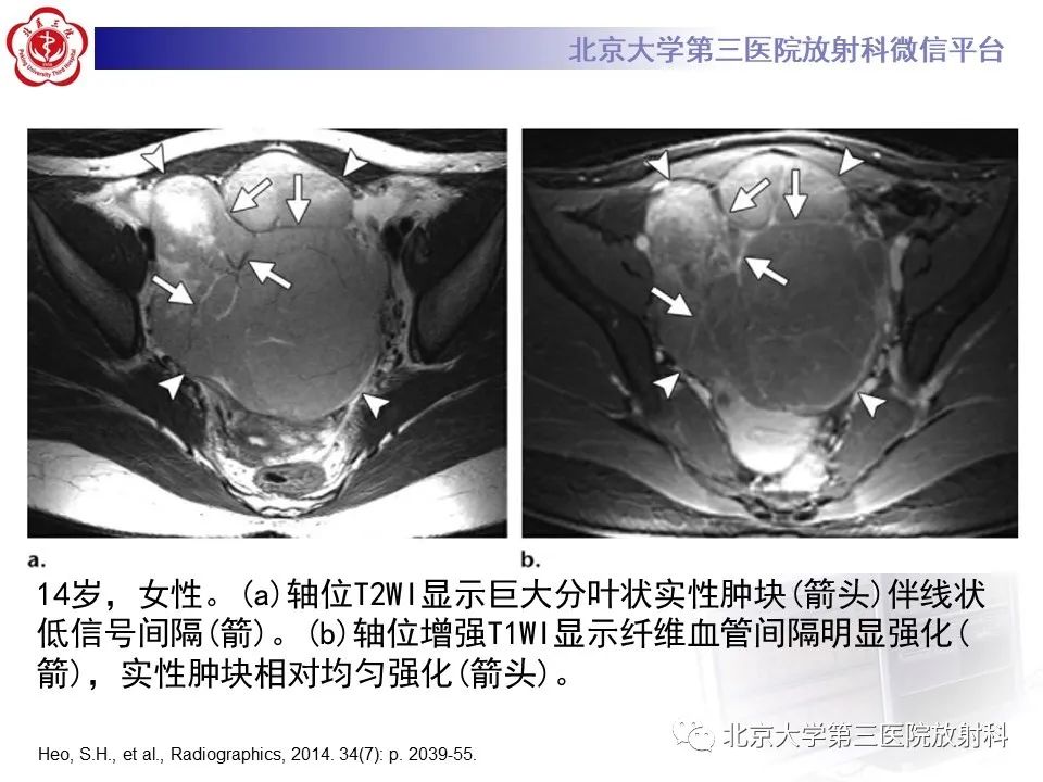 影像PPT - 【PPT】卵巢无性细胞瘤-26
