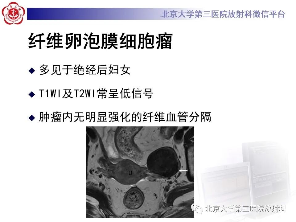 影像PPT - 【PPT】卵巢无性细胞瘤-28