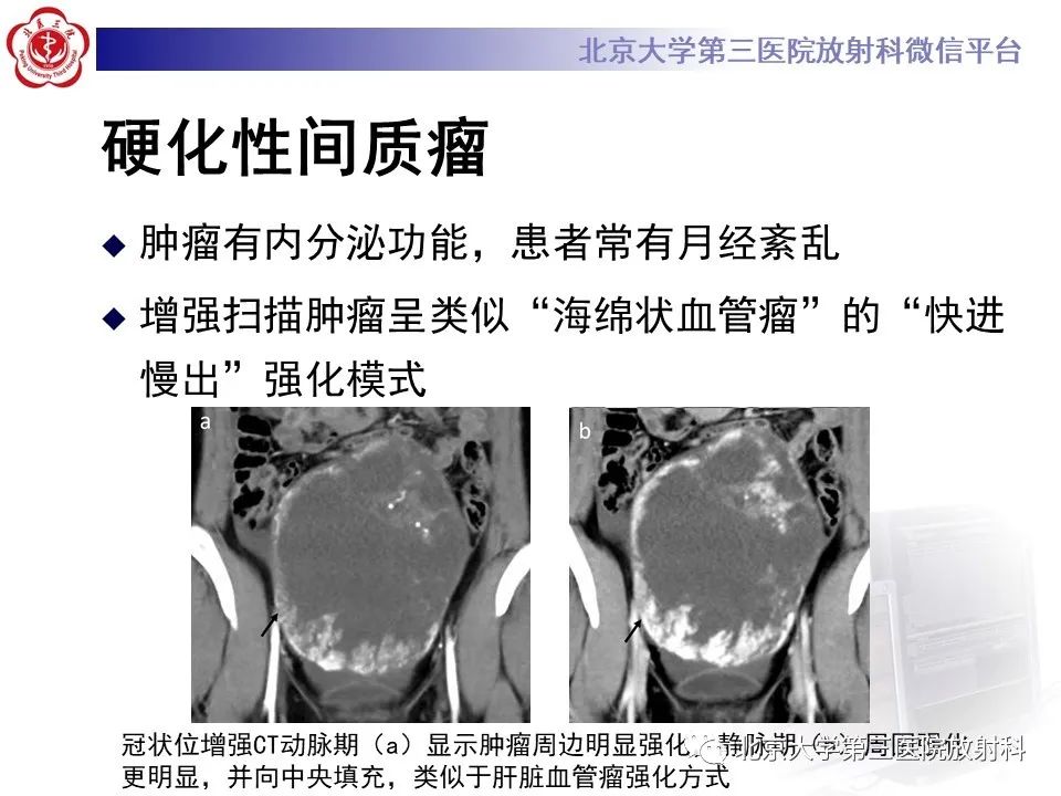 影像PPT - 【PPT】卵巢无性细胞瘤-29