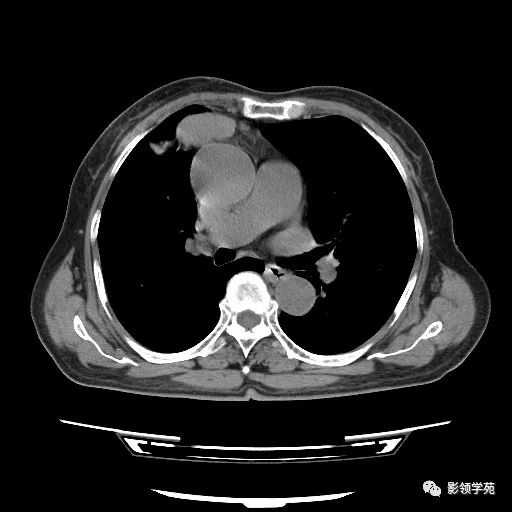 影像PPT - 【病例】胸腺小细胞癌1例CT-1 影像PPT - 【病例】胸腺小细胞癌1例CT-1