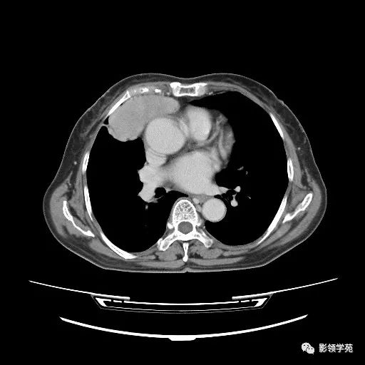影像PPT - 【病例】胸腺小细胞癌1例CT-9 影像PPT - 【病例】胸腺小细胞癌1例CT-9