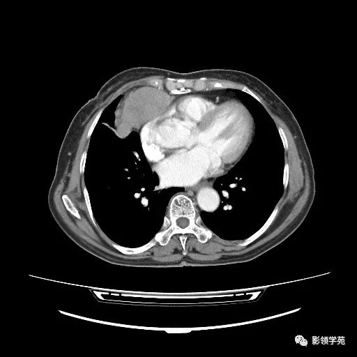影像PPT - 【病例】胸腺小细胞癌1例CT-7 影像PPT - 【病例】胸腺小细胞癌1例CT-7