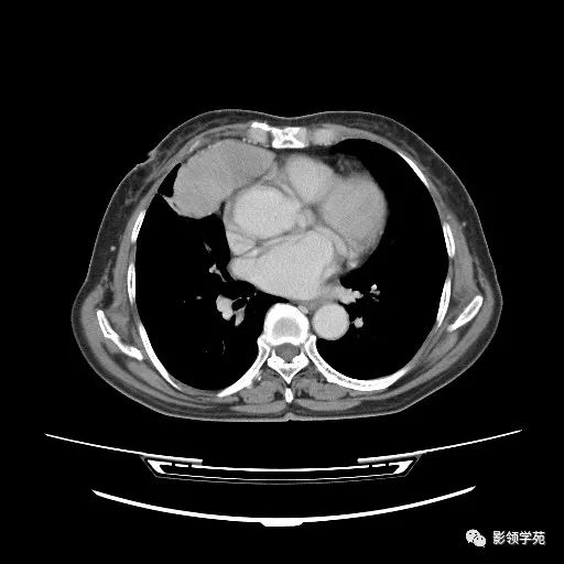 影像PPT - 【病例】胸腺小细胞癌1例CT-10 影像PPT - 【病例】胸腺小细胞癌1例CT-10