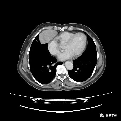 影像PPT - 【病例】胸腺小细胞癌1例CT-11 影像PPT - 【病例】胸腺小细胞癌1例CT-11