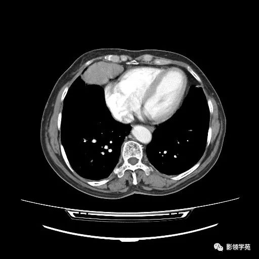 影像PPT - 【病例】胸腺小细胞癌1例CT-8 影像PPT - 【病例】胸腺小细胞癌1例CT-8