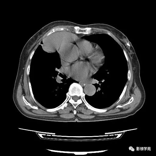影像PPT - 【病例】胸腺小细胞癌1例CT-2 影像PPT - 【病例】胸腺小细胞癌1例CT-2
