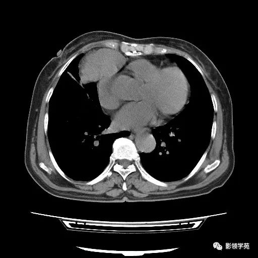 影像PPT - 【病例】胸腺小细胞癌1例CT-3 影像PPT - 【病例】胸腺小细胞癌1例CT-3