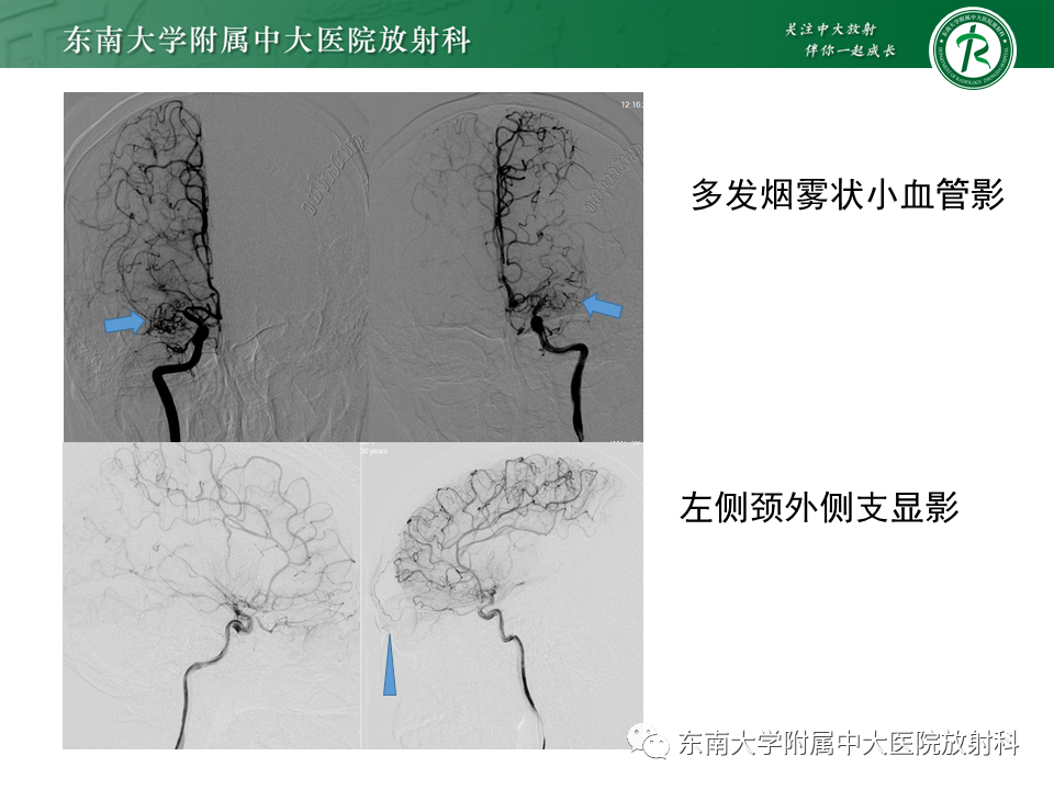 影像PPT - 【PPT】烟雾病-5