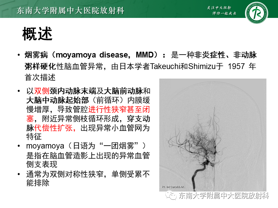 影像PPT - 【PPT】烟雾病-7