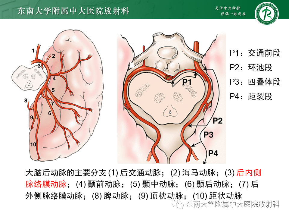 影像PPT - 【PPT】烟雾病-11