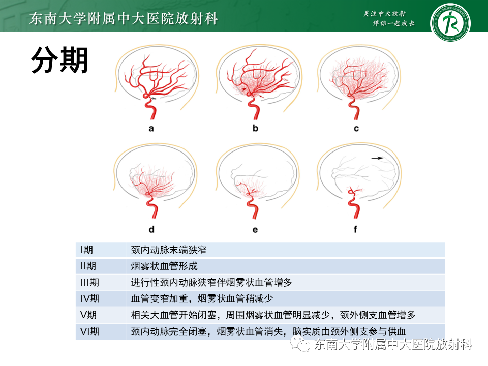 影像PPT - 【PPT】烟雾病-16