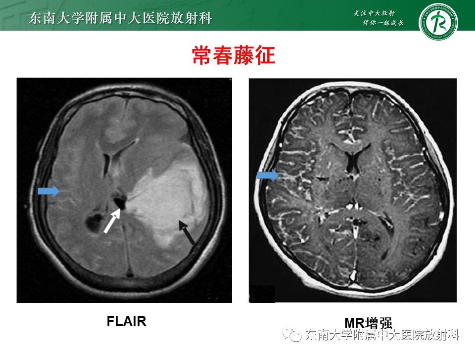 影像PPT - 【PPT】烟雾病-22