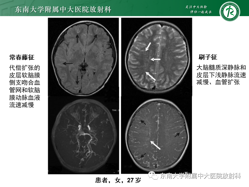 影像PPT - 【PPT】烟雾病-23